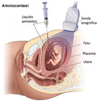 Amniocentesi: prelievo di liquido amniotico